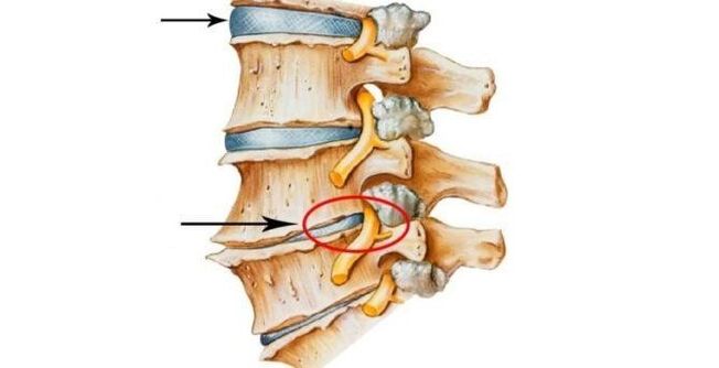 disco espinal sano y dañado con osteocondrosis cervical
