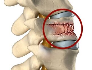 Las causas del dolor de espalda pueden ser enfermedades de la columna vertebral y los discos intervertebrales. 