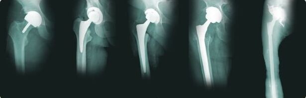 opciones para el reemplazo de cadera en artrosis