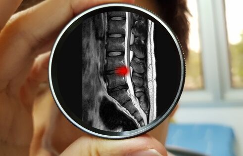 La consecuencia de ignorar el dolor lumbar puede ser una hernia de disco. 