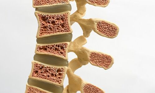 La osteoporosis es una de las causas del dolor lumbar. 
