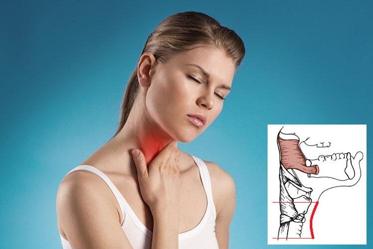 Dolor de garganta con osteocondrosis cervical debido a compresión nerviosa. 