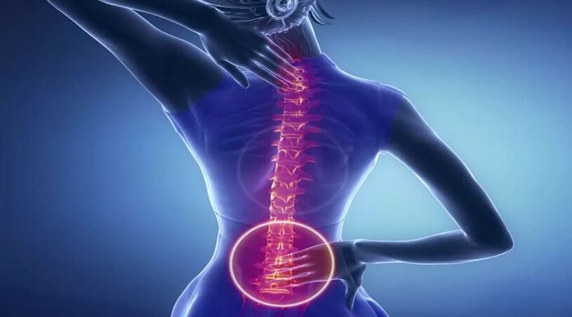 Osteocondrosis de la columna