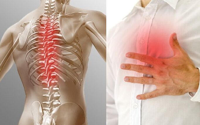 Osteocondrosis torácica y dolor en el pecho.