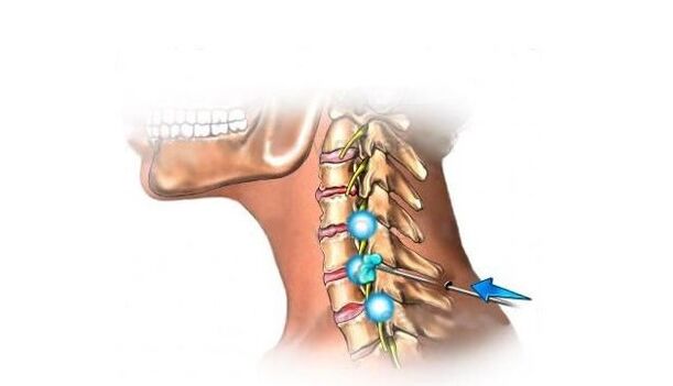 osteocondrosis de la columna cervical