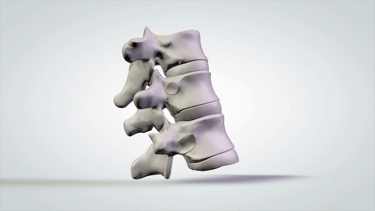 Daño a la columna vertebral debido a la osteocondrosis cervical.