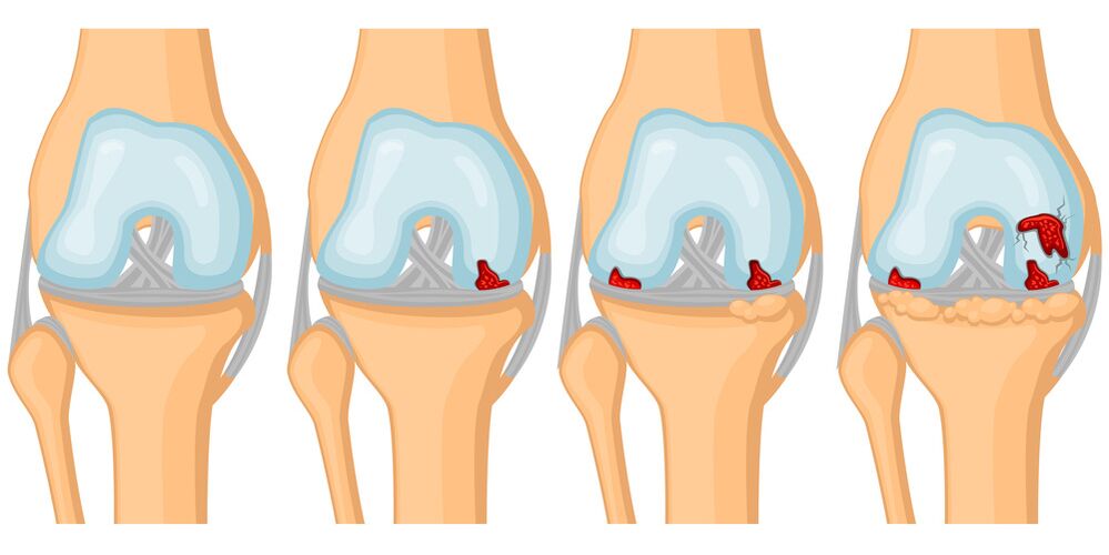 Grado de desarrollo de la artrosis articular.