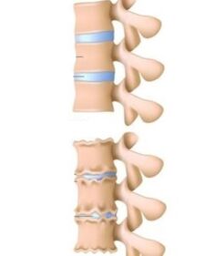 causas de la osteocondrosis