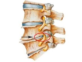 signos y síntomas de osteocondrosis